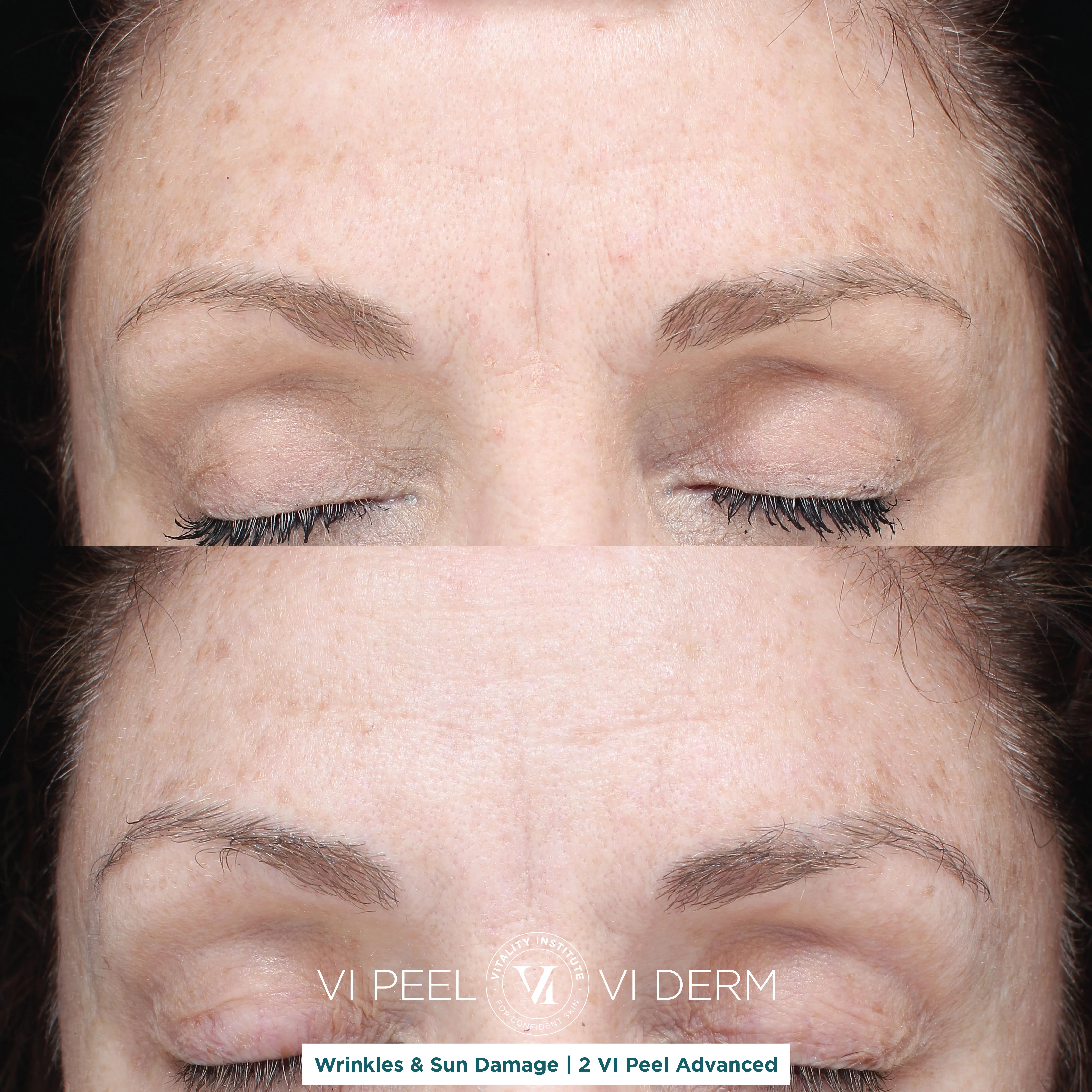 Wrinkles & Sun Damage — 2 VI Peel Advanced
