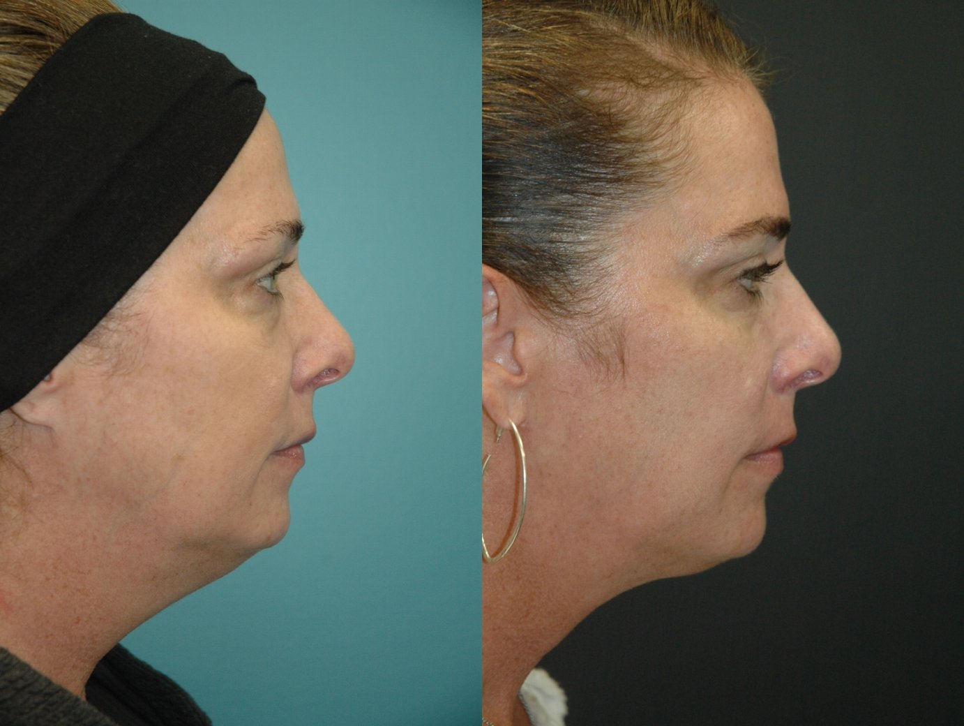 Morpheus8 with FaceTite before and after photographs, case 12, with the before photograph on the left and the after photograph on the right