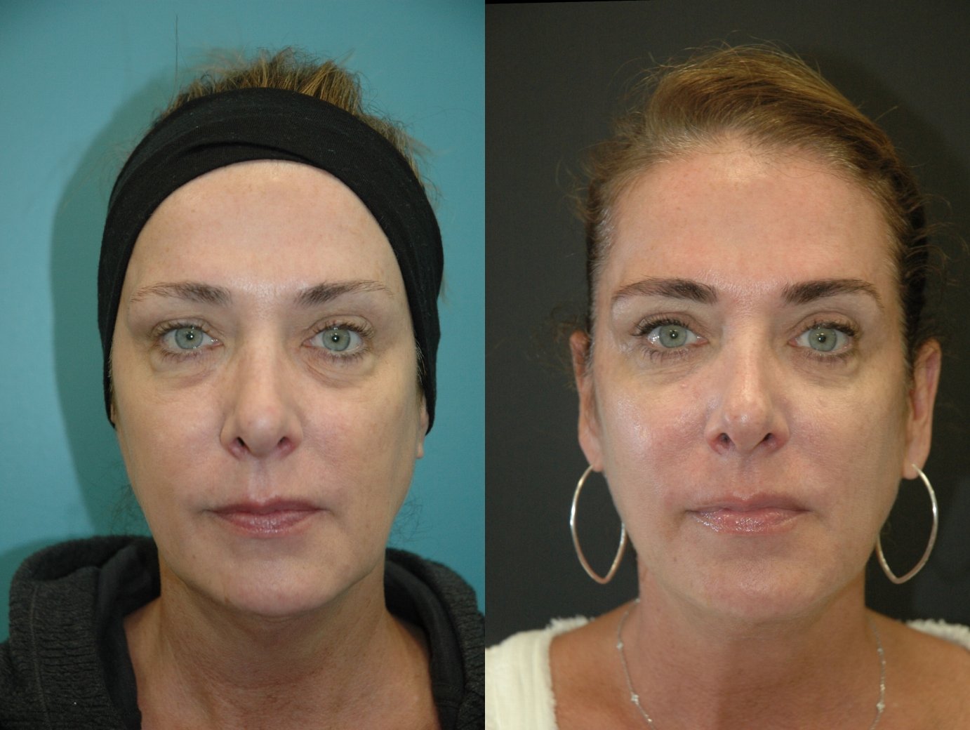 Morpheus8 with FaceTite before and after photographs, case 6, with the before photograph on the left and the after photograph on the right