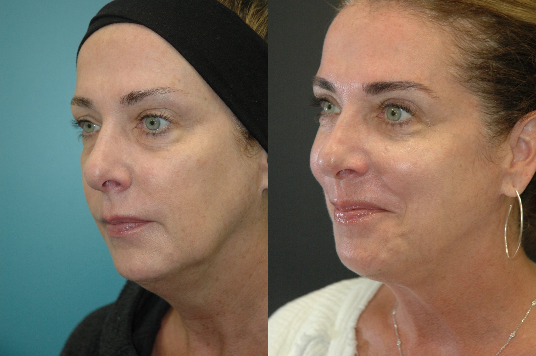 Morpheus8 with FaceTite before and after photographs, case 9, with the before photograph on the left and the after photograph on the right