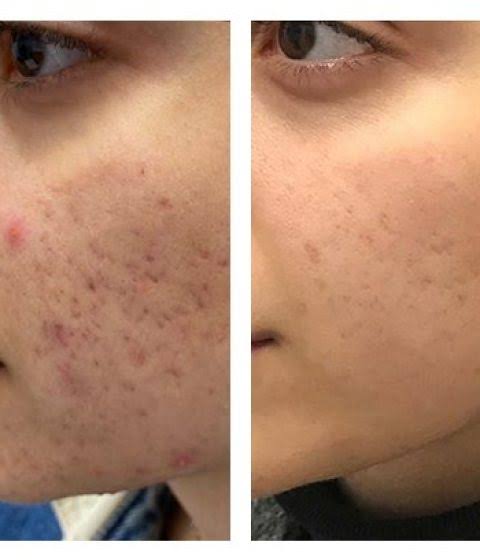 Acne marks before and after