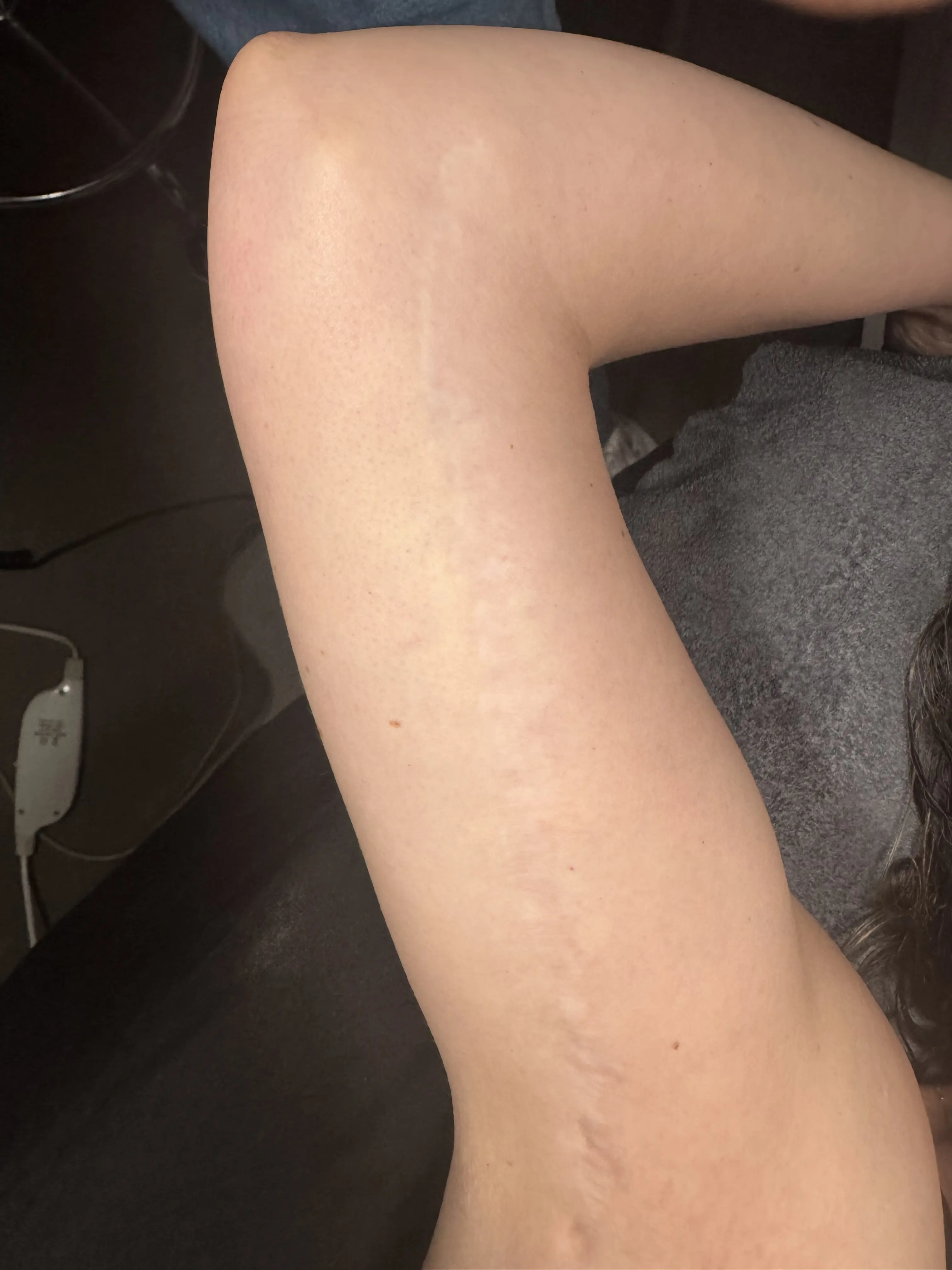 Arm after scar revision — scar significantly faded