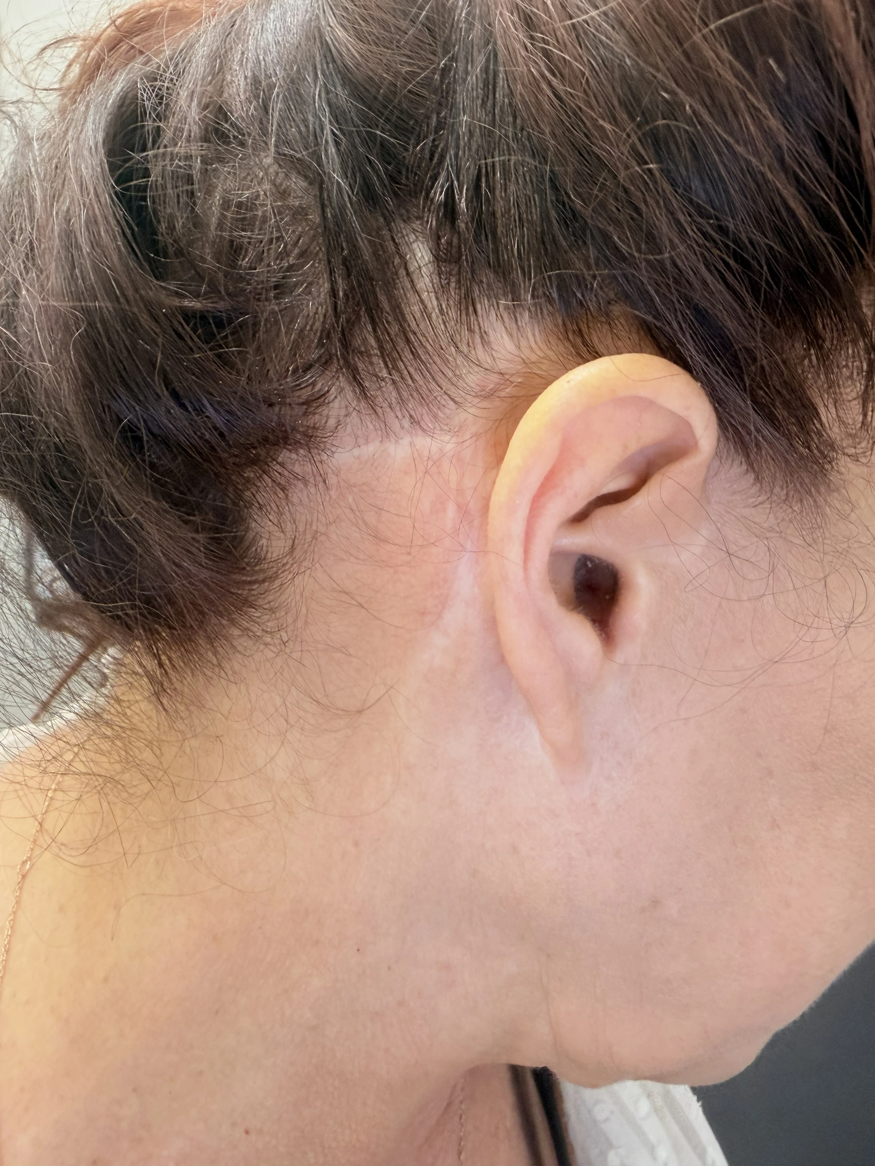 Neck and ear area after scar revision — nearly invisible