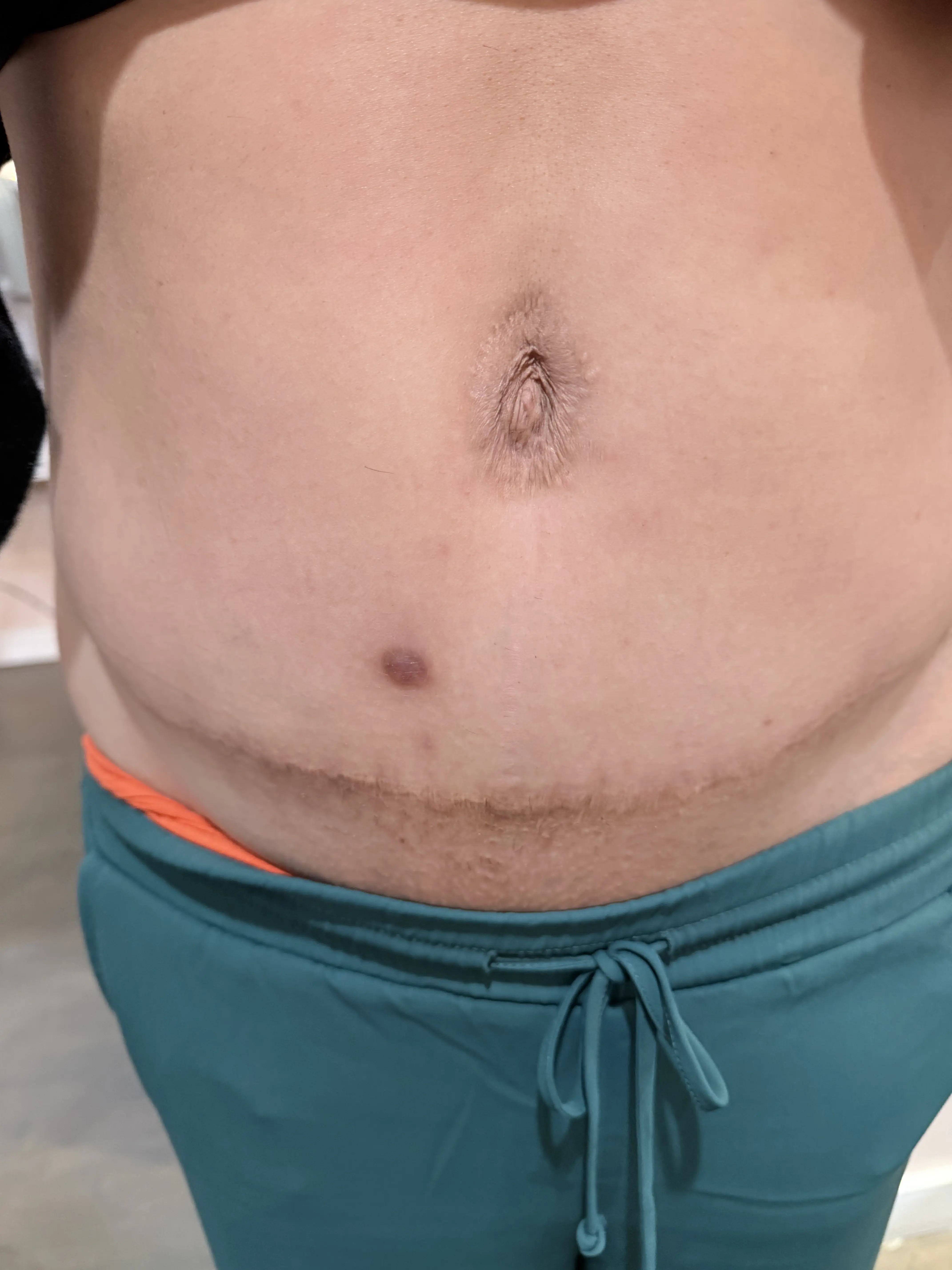 Abdomen after c-section scar revision
