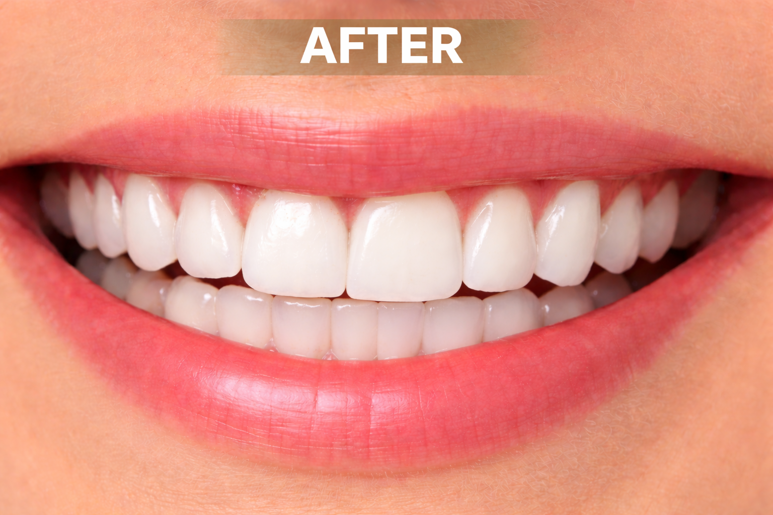 After teeth whitening