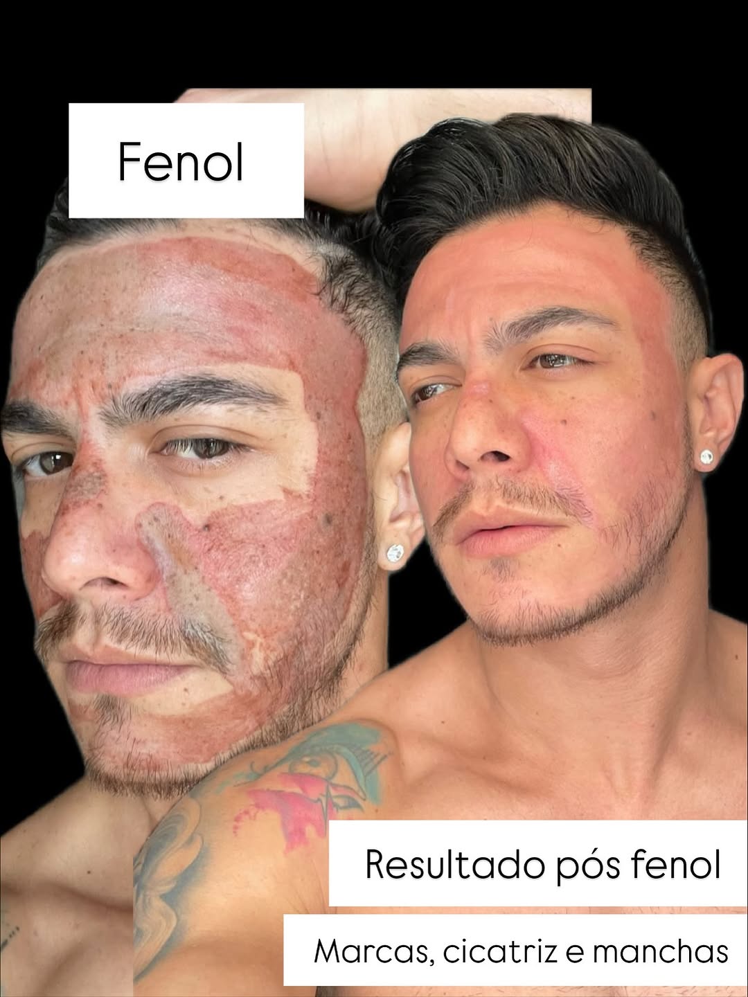Fenol: Resultado pós fenol