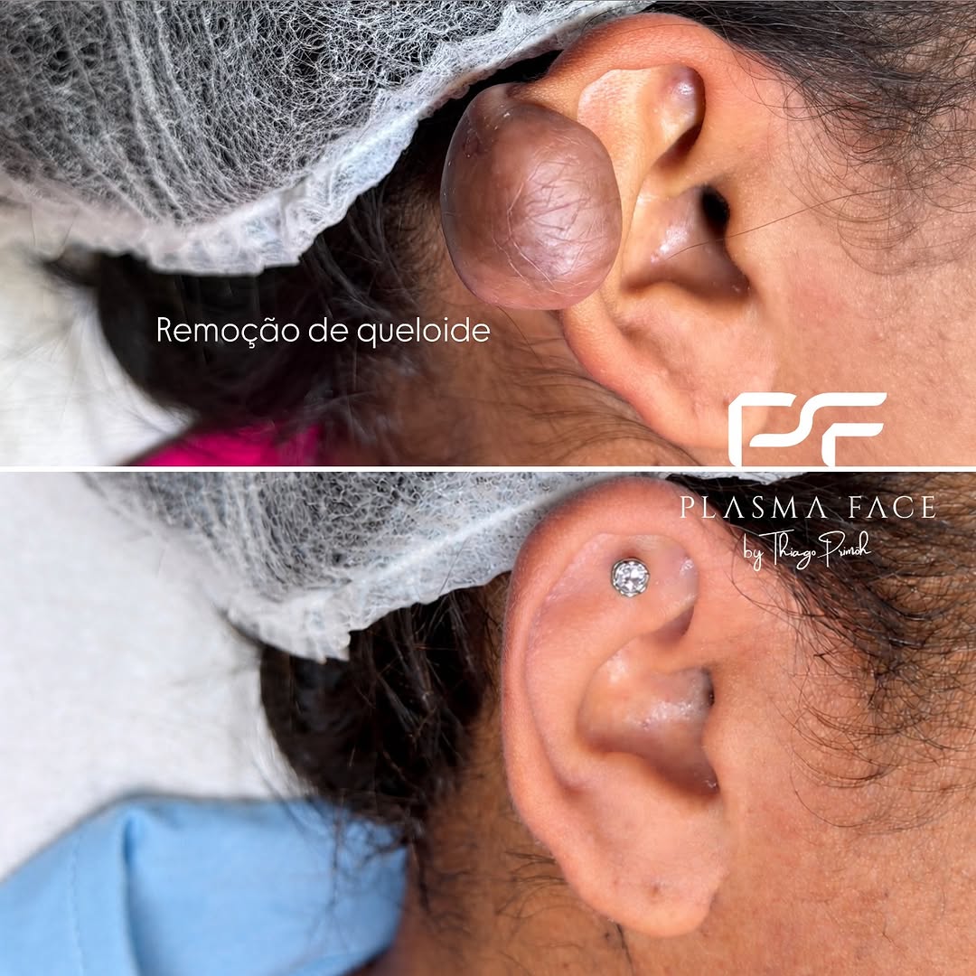 Resultado - Remoção Avançada de Queloide