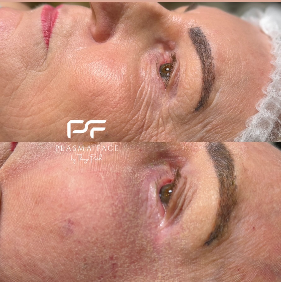 Resultado - Rejuvenescimento da Região dos Olhos