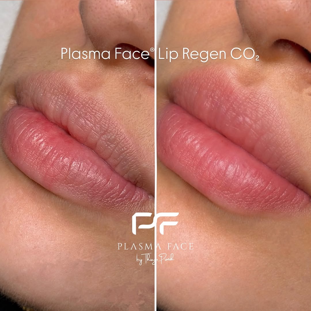 Resultado - Rejuvenescimento Labial com CO₂ Fracionado