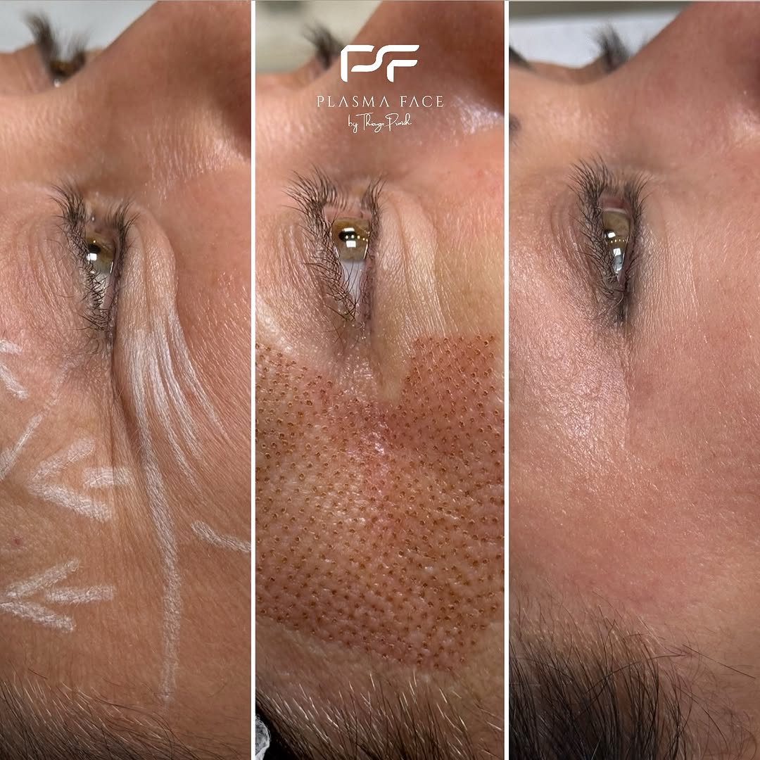 Resultado - Evolução com Jett Plasma