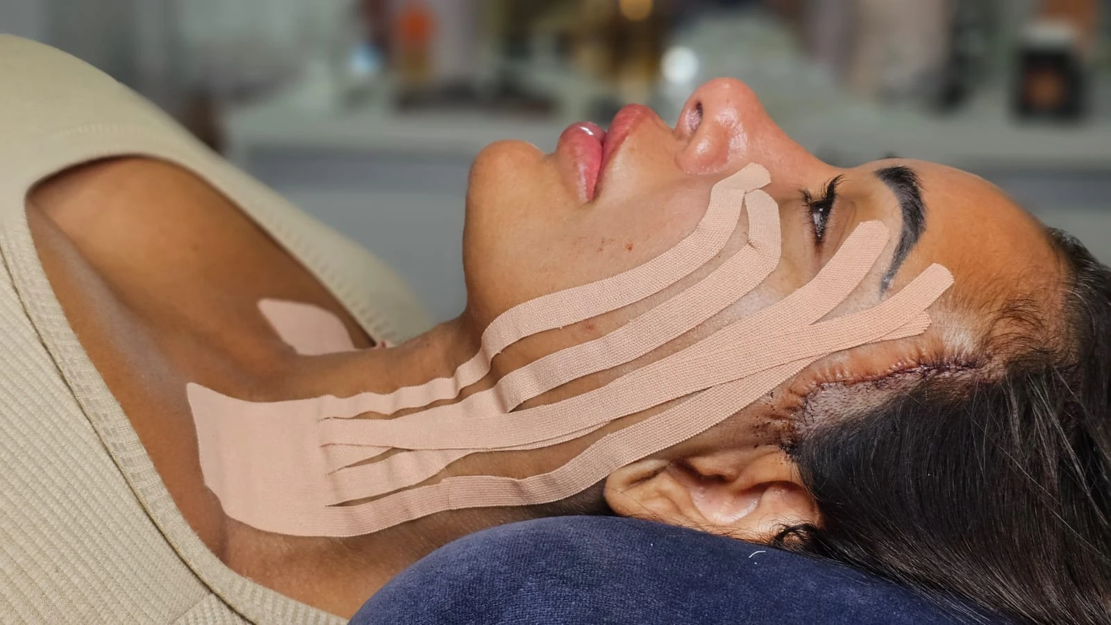 Antes do tratamento — taping facial pós-operatório