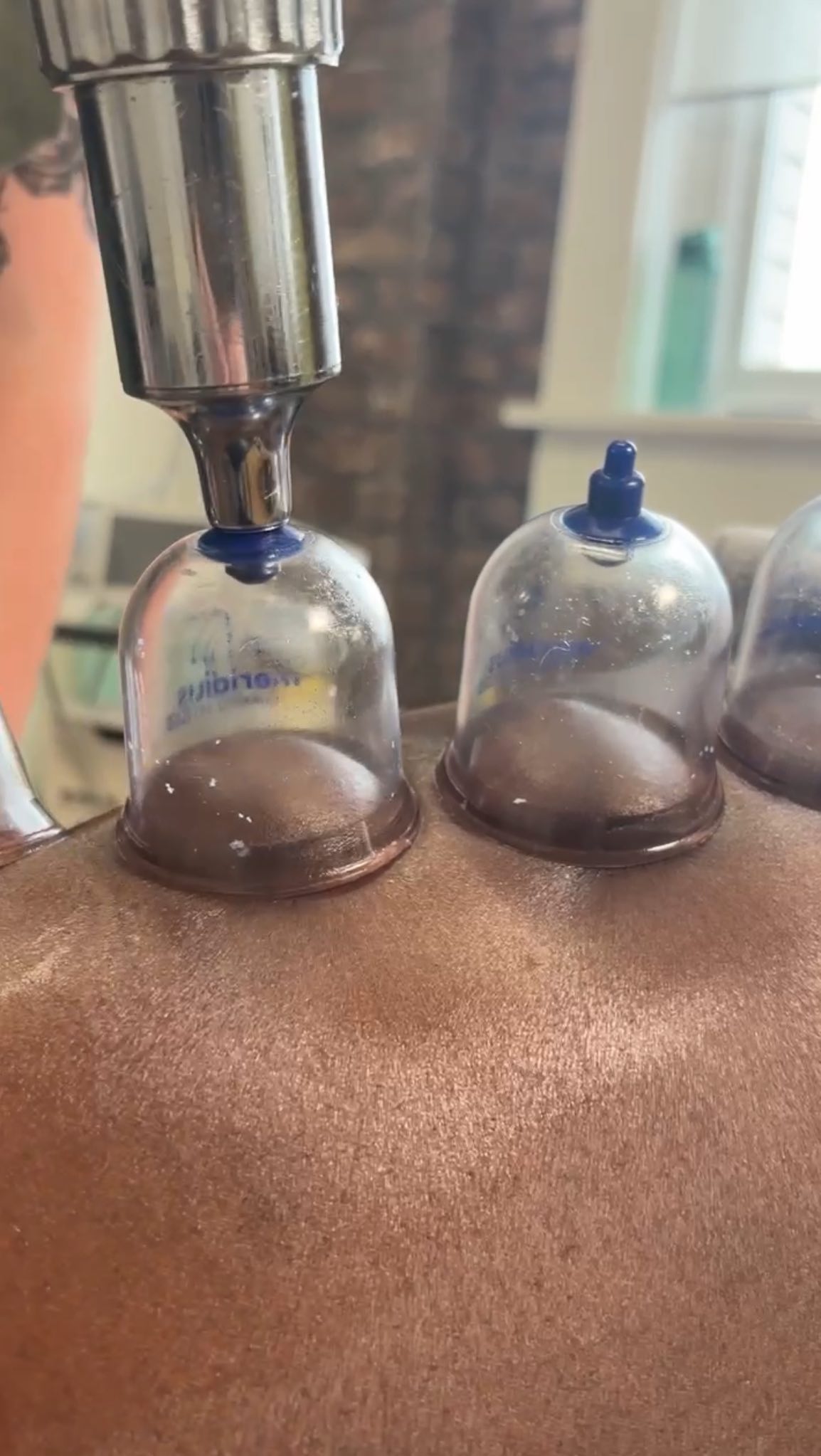 Cupping therapy cups applied during treatment at City Chiropractic