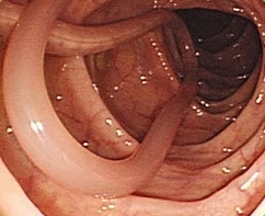 Examen endoscópico mostrando Ascaris Lumbricoides en el intestino