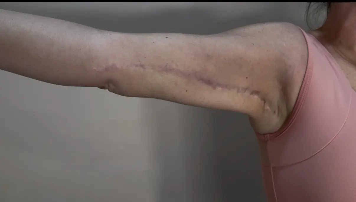 Arm with raised surgical scar before revision