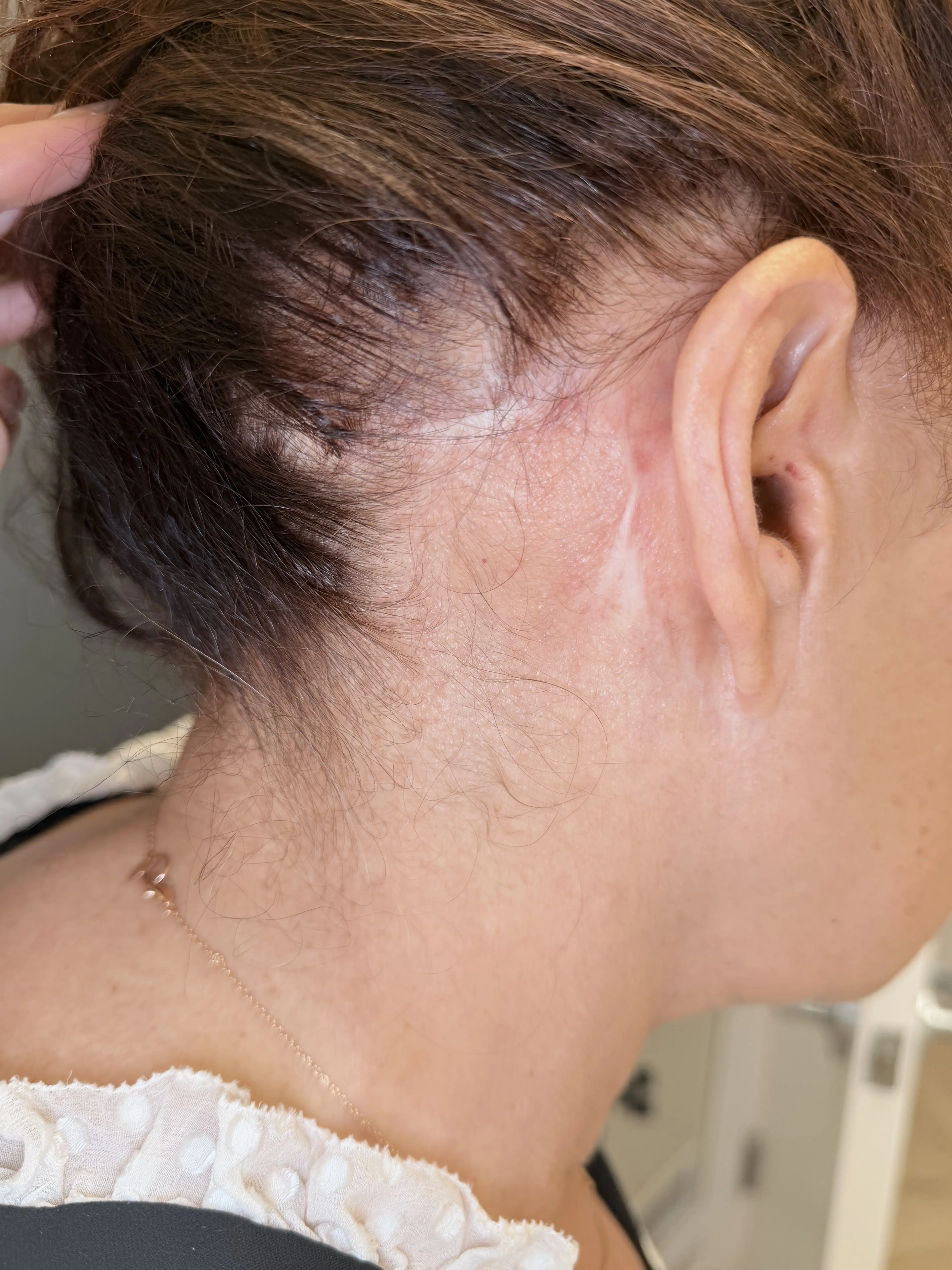 Neck and ear area with surgical scar before revision