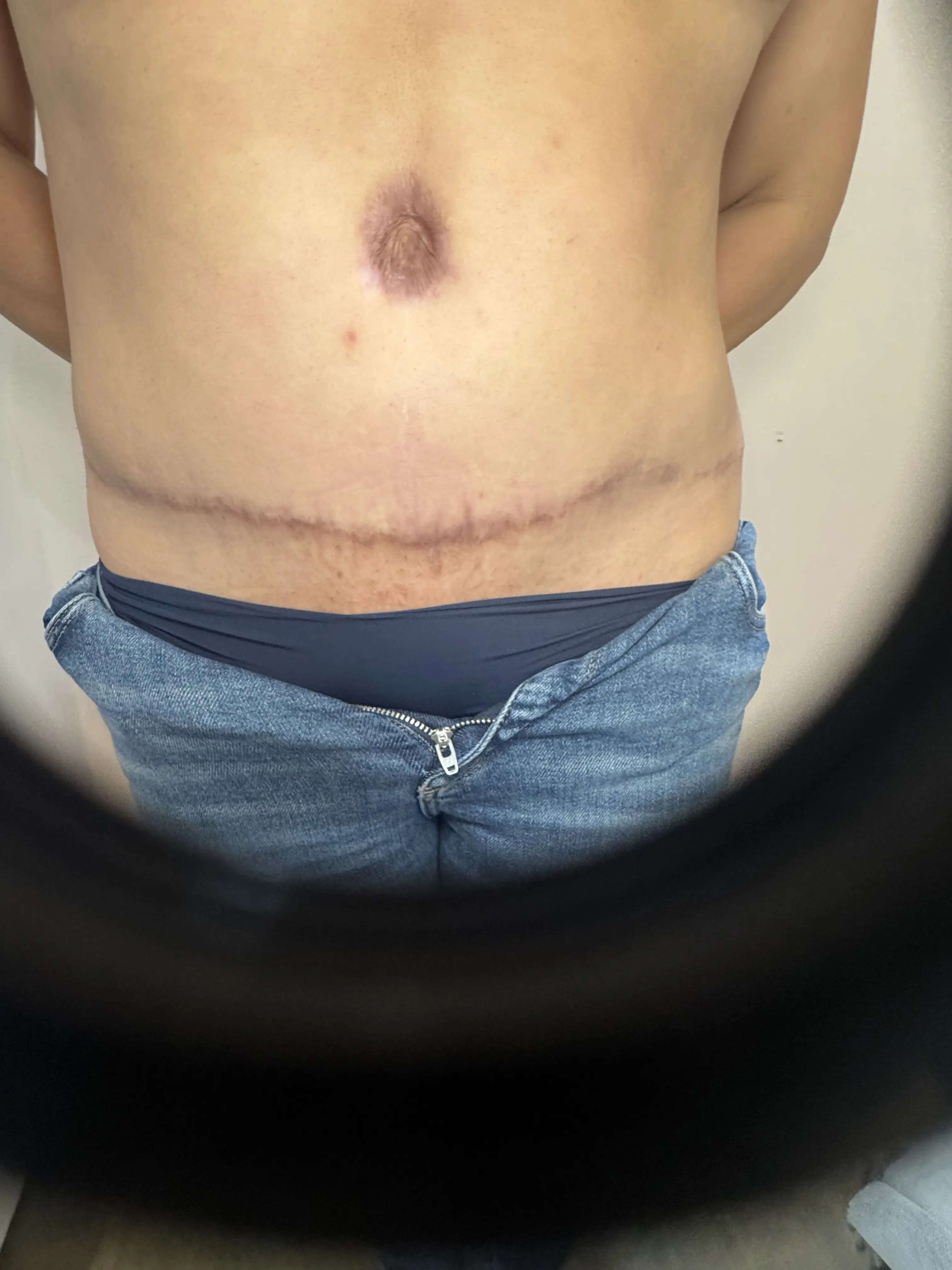 Abdomen with c-section scar before revision