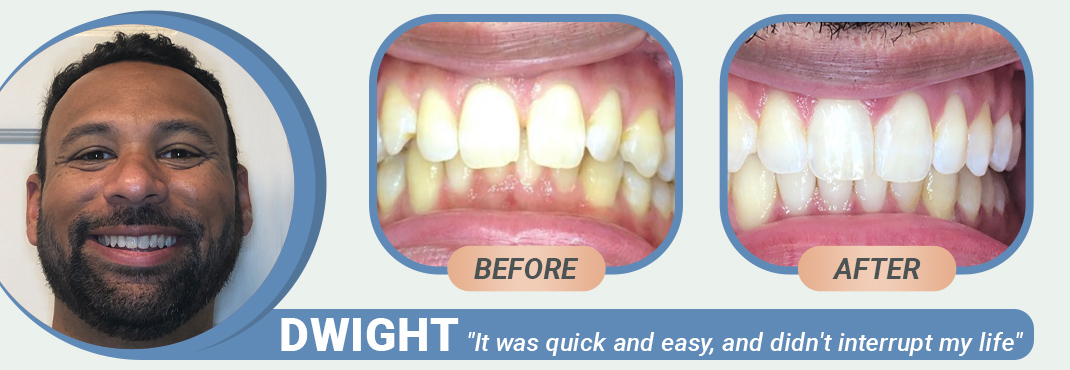 Dwight before and after Invisalign treatment