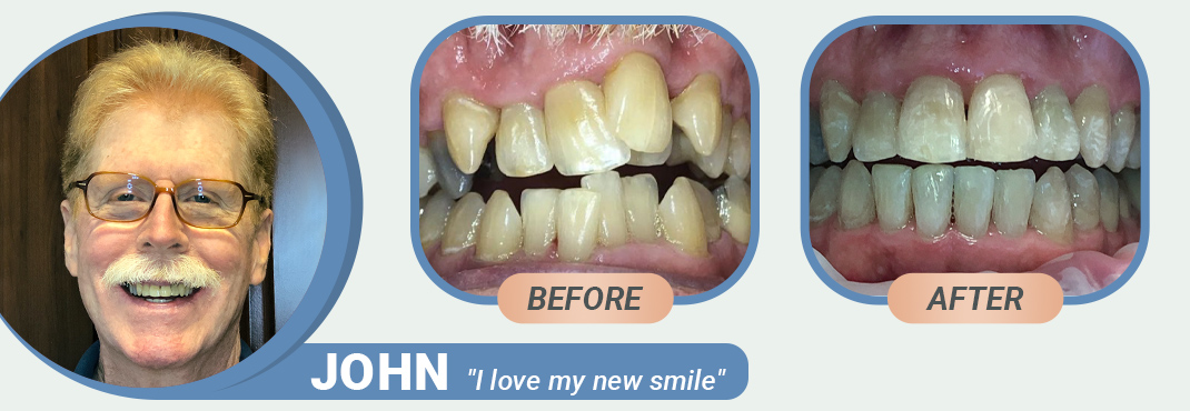 John before and after Invisalign treatment