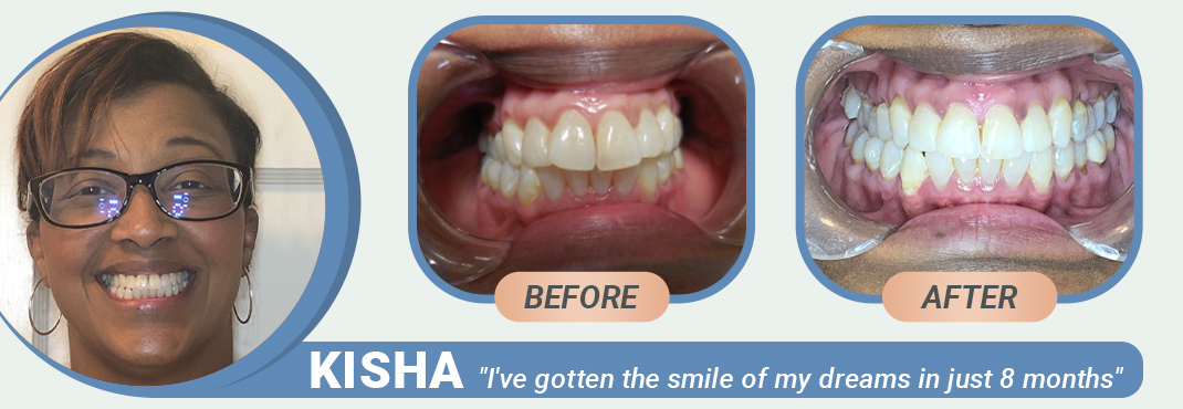 Kisha before and after Invisalign treatment