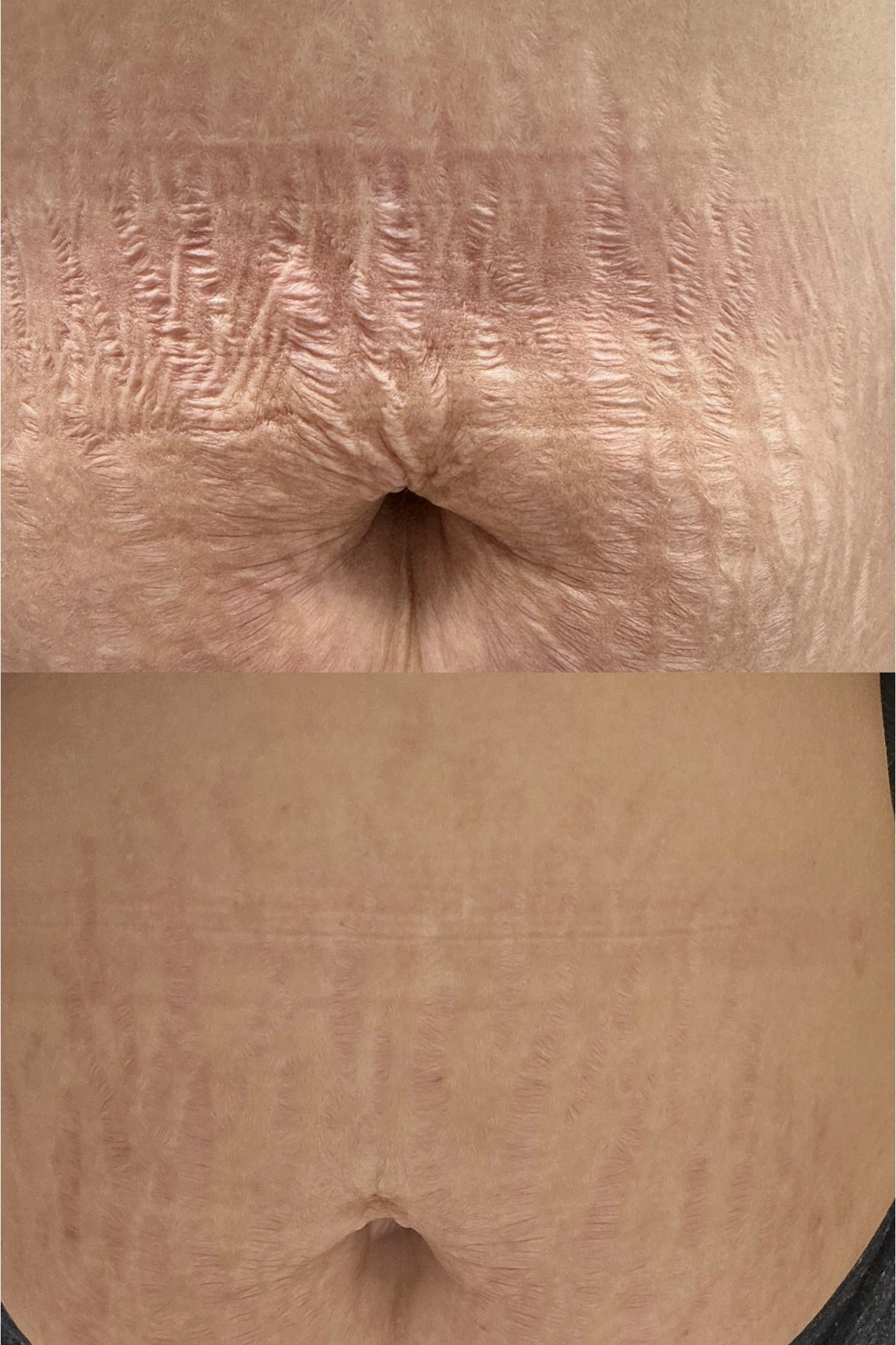 Abdomen before and after stretch mark revision — dramatic reduction in visibility