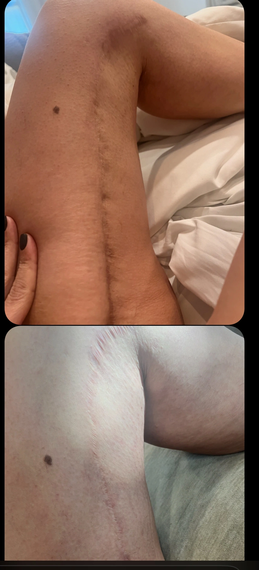 Leg scar before and after revision — raised scar flattened