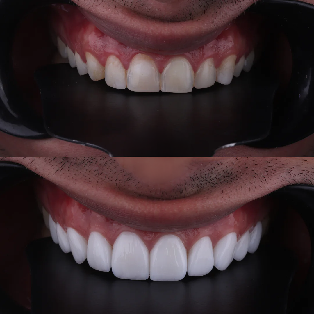 Before and after smile transformation with dental retractors