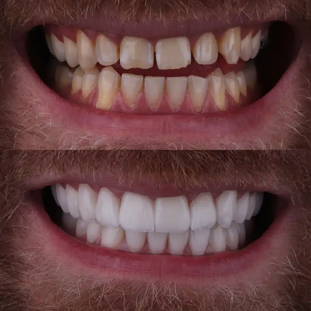 Before and after smile transformation with facial hair