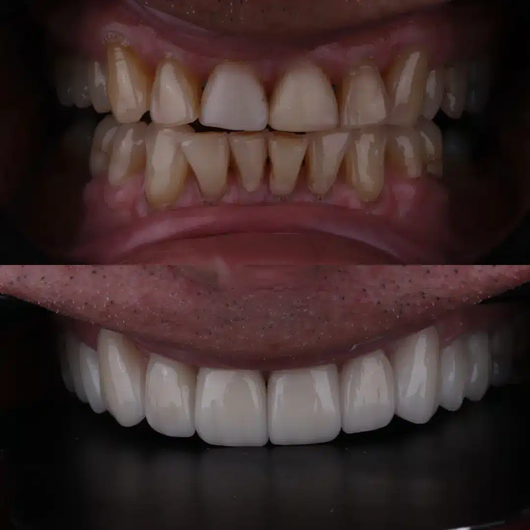 Before and after smile transformation with portrait