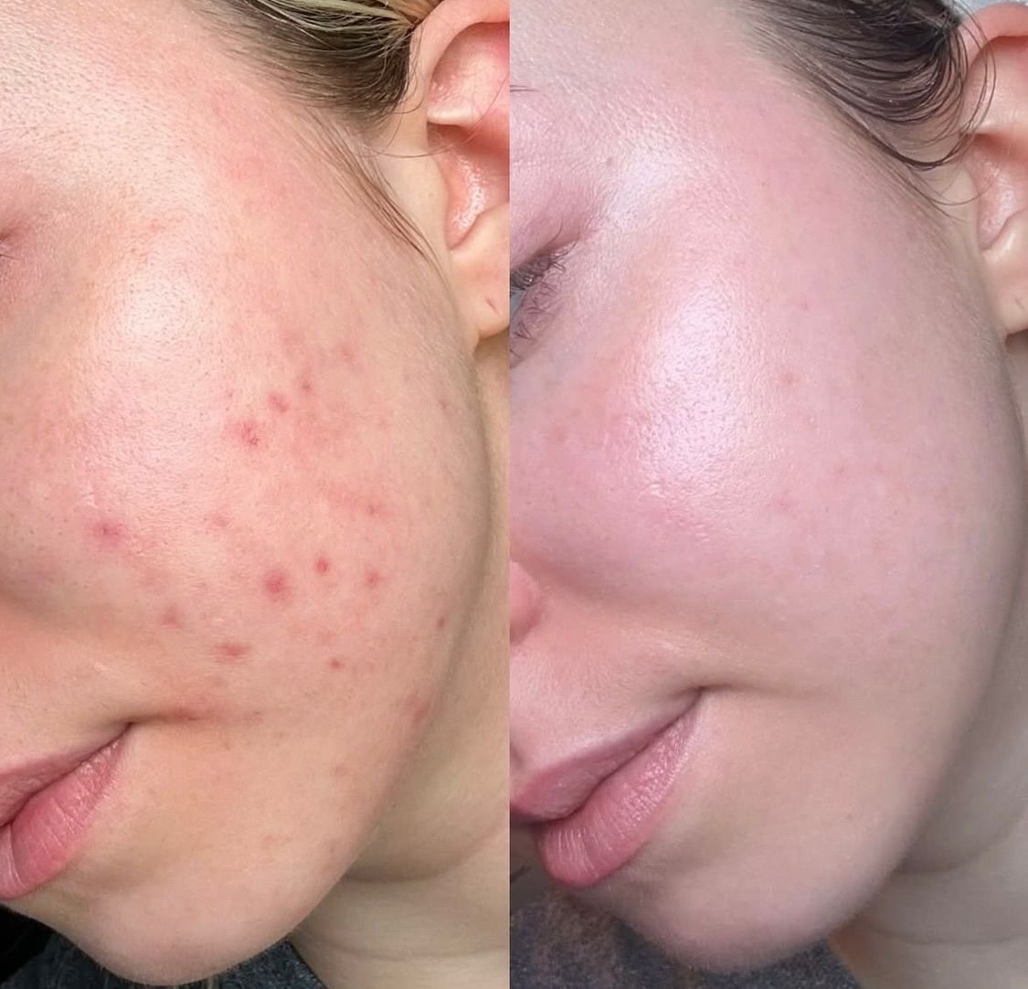 Breakouts before and after