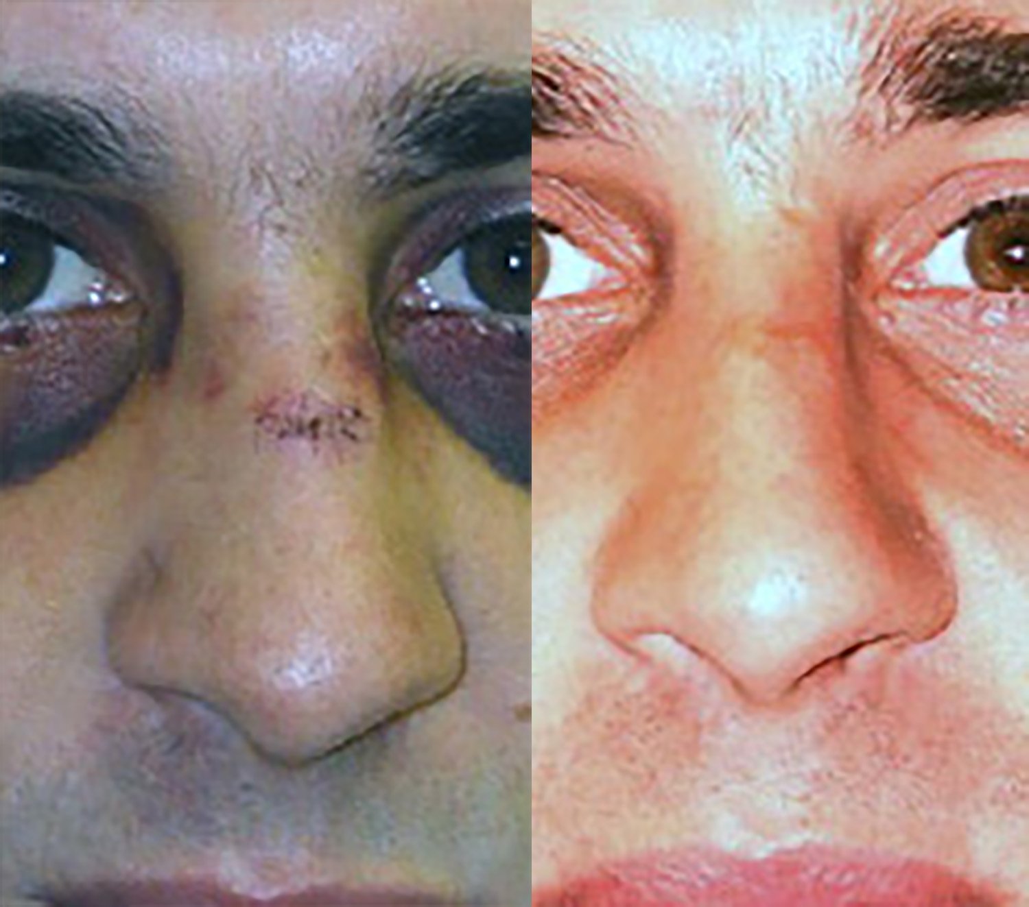Dr. Kirwan patient result — Dr. Laurence Kirwan. Broken nose with scar, front view. Before: left; After: right.