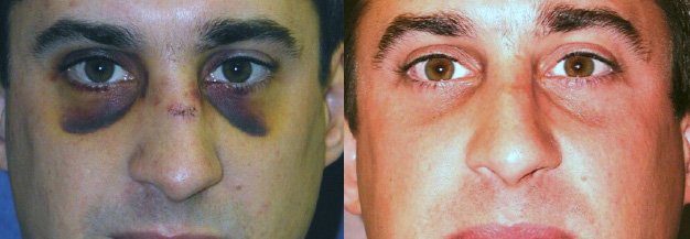 Dr. Kirwan patient result — Dr. Laurence Kirwan. Broken nose with laceration and bruising, front view. Before: left; After: right.