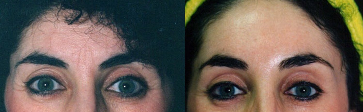 Brow lift before and after photographs, case 6, with the before photograph on the left and the after photograph on the right