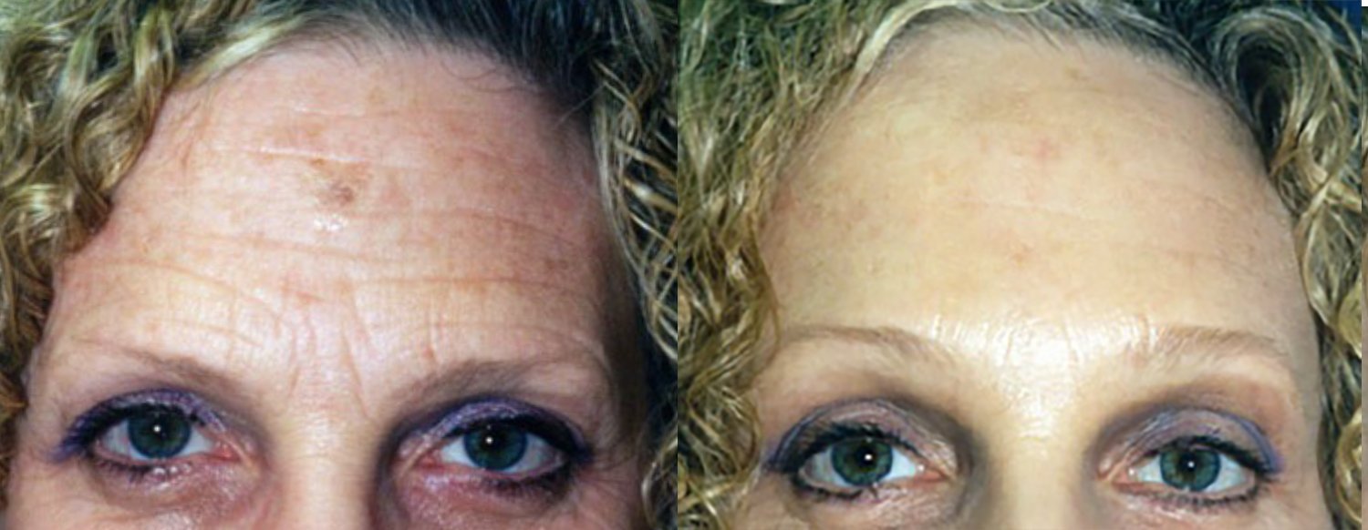 Brow lift before and after photographs, case 7, with the before photograph on the left and the after photograph on the right