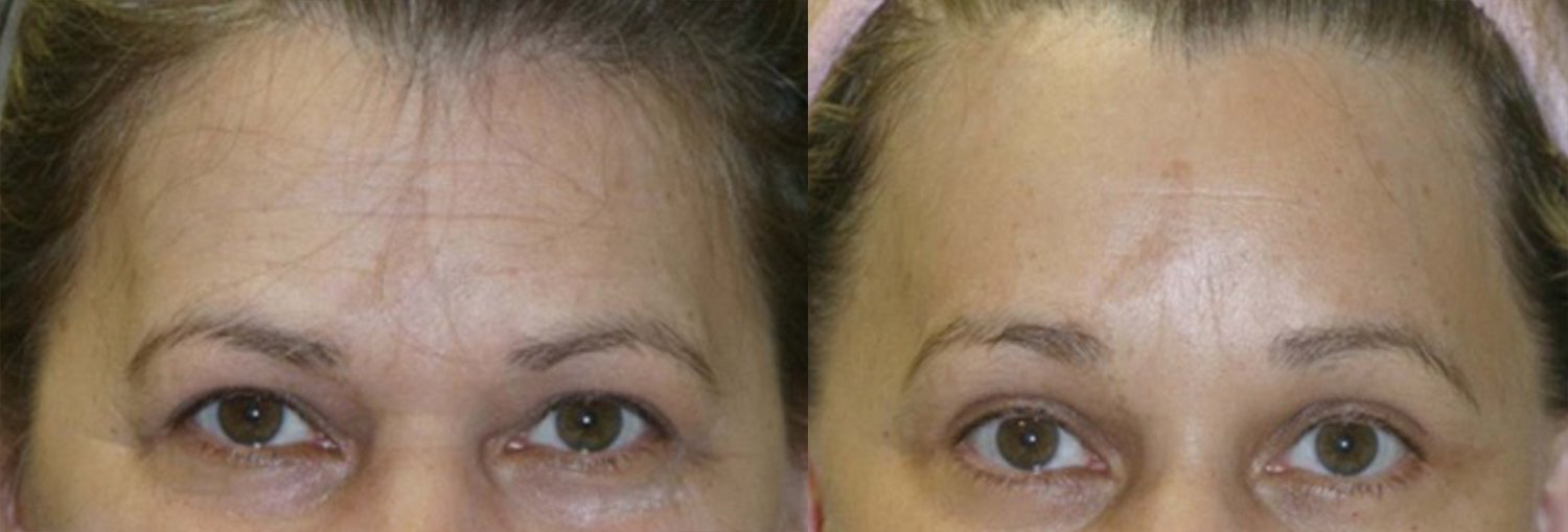 Brow lift before and after photographs, case 8, with the before photograph on the left and the after photograph on the right