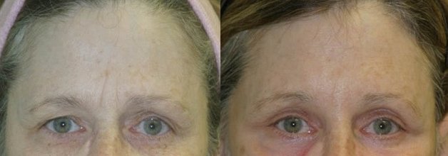 Brow lift before and after photographs, case 9, with the before photograph on the left and the after photograph on the right