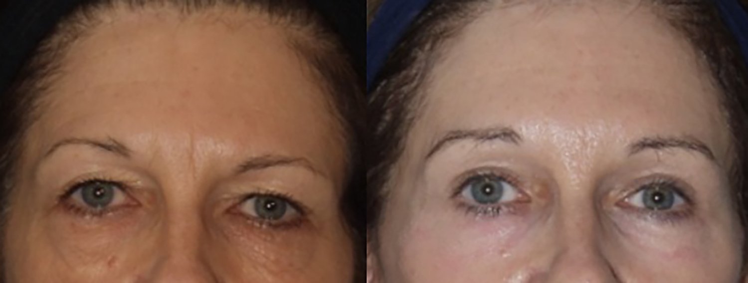 Brow lift before and after photographs, case 10, with the before photograph on the left and the after photograph on the right