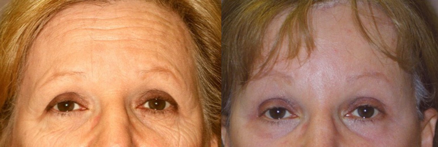 Brow lift before and after photographs, case 11, with the before photograph on the left and the after photograph on the right