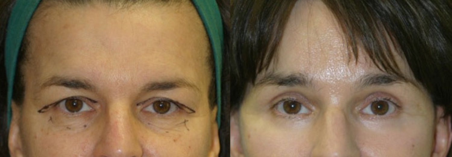 Brow lift before and after photographs, case 12, with the before photograph on the left and the after photograph on the right