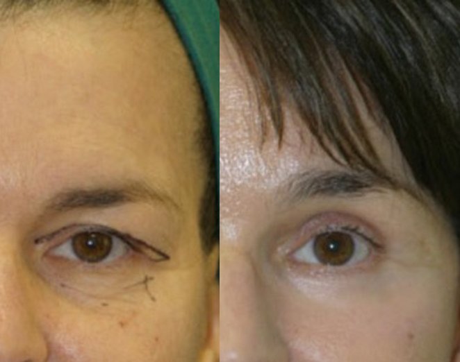 Dr. Kirwan patient result — Dr. Laurence Kirwan. Brow lift with upper and lower eyelid surgery and facelift, left eye close-up. Combined-treatment result; visible changes cannot be attributed to one procedure alone.. Before: left; After: right.