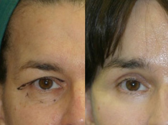 Dr. Kirwan patient result — Dr. Laurence Kirwan. Brow lift with upper and lower eyelid surgery and facelift, right eye close-up. Combined-treatment result; visible changes cannot be attributed to one procedure alone.. Before: left; After: right.