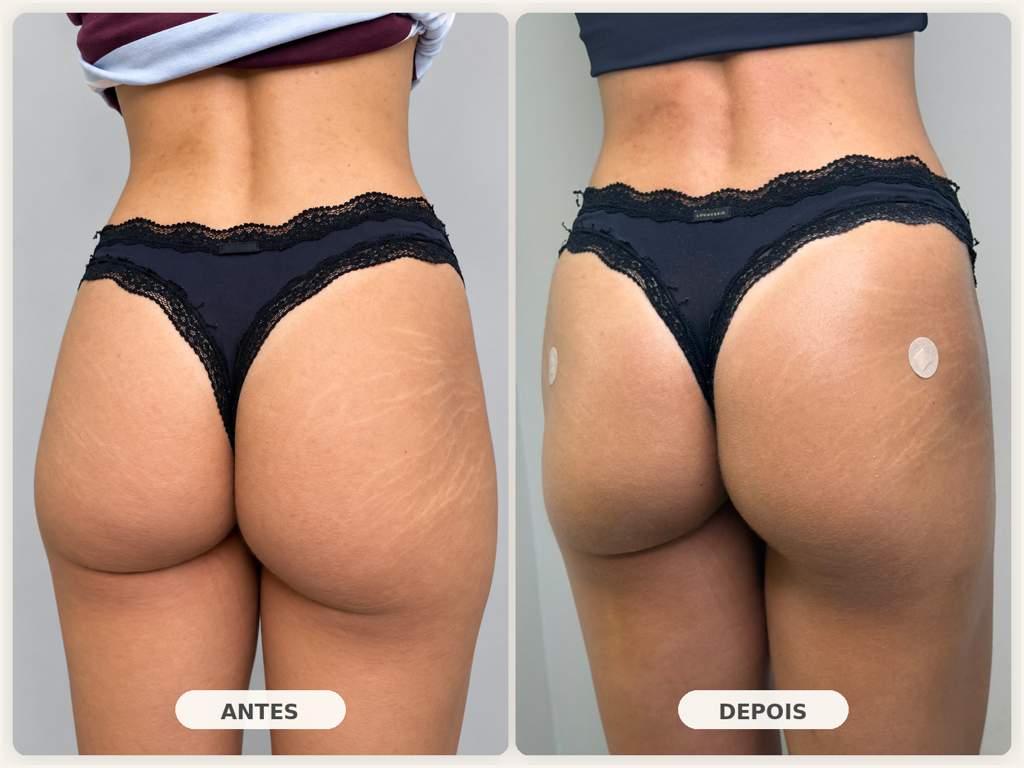 Comparativo de tratamento corporal com imagens de antes e depois