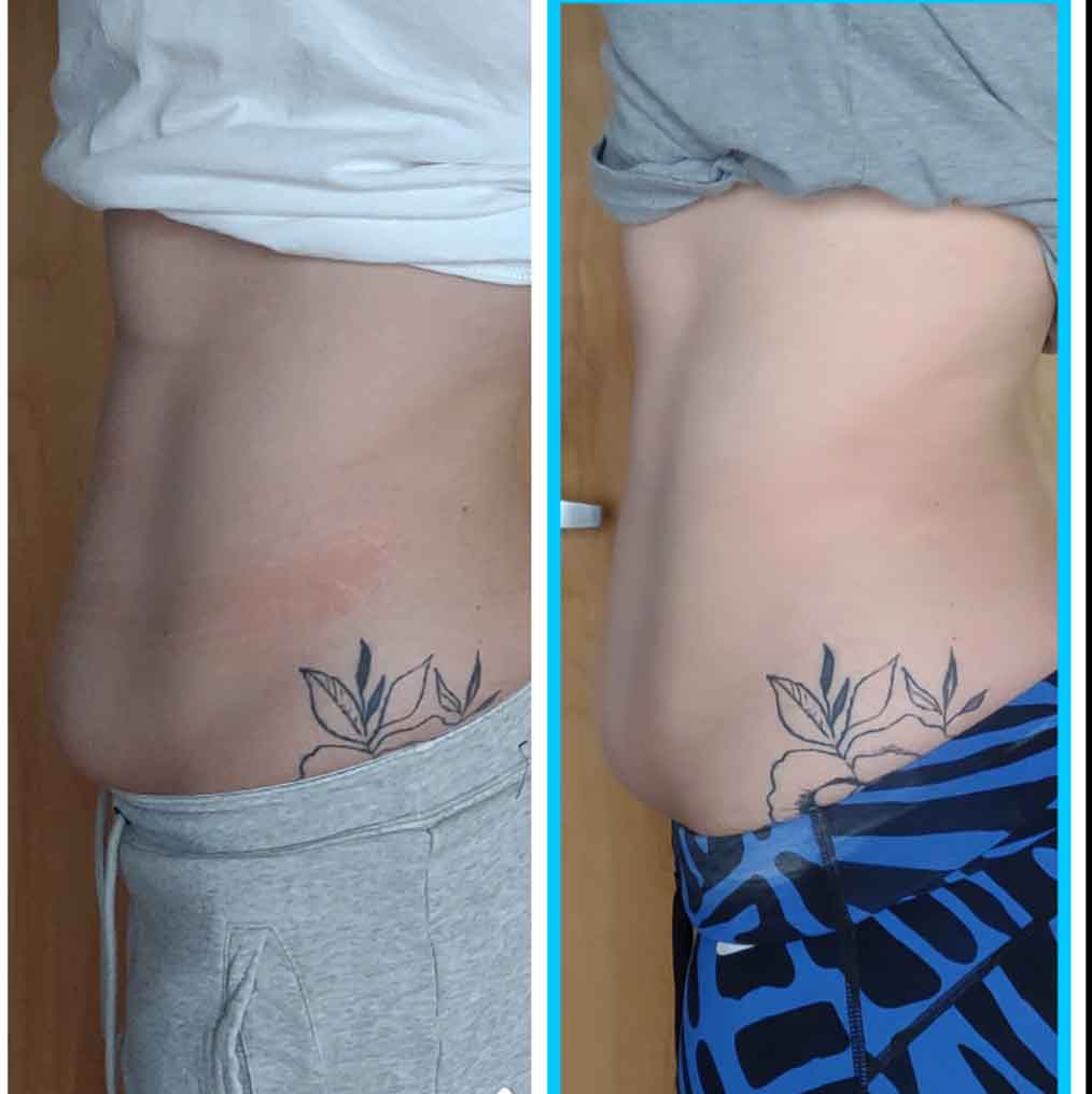 Cryo-Slimming before and after lower body treatment results