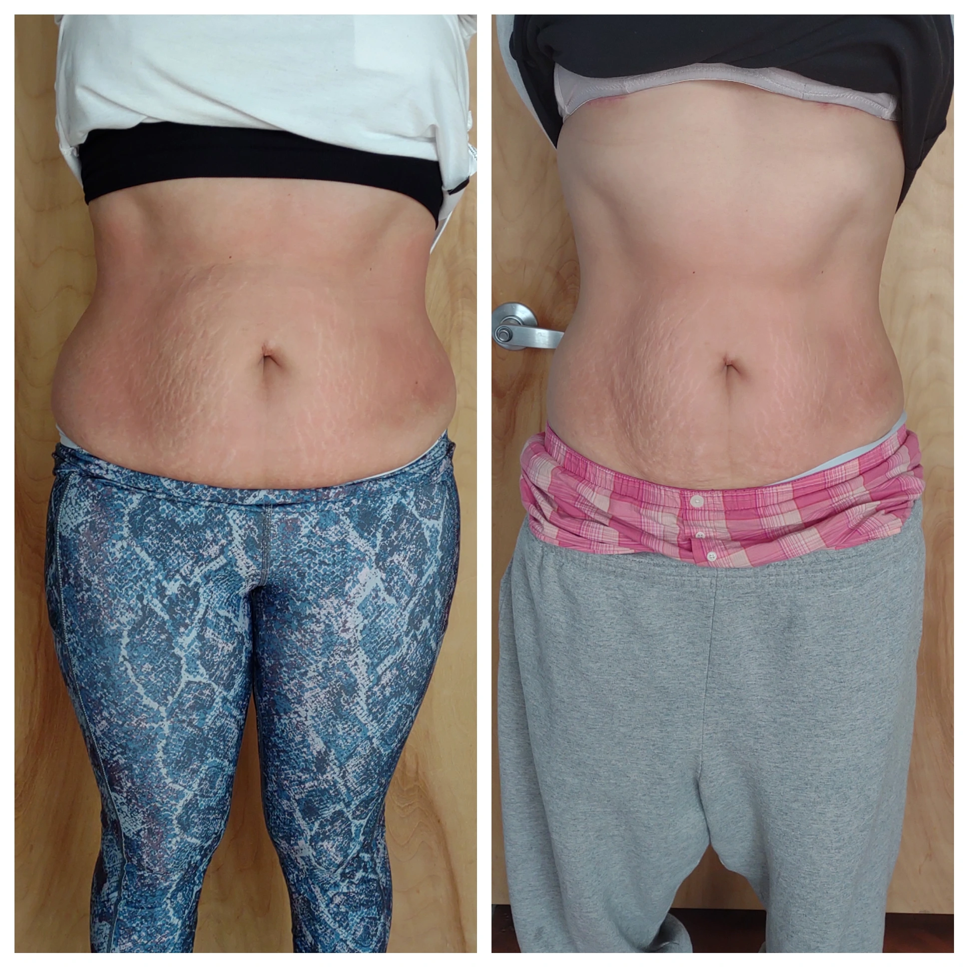 Cryo-Slimming before and after abdominal treatment results