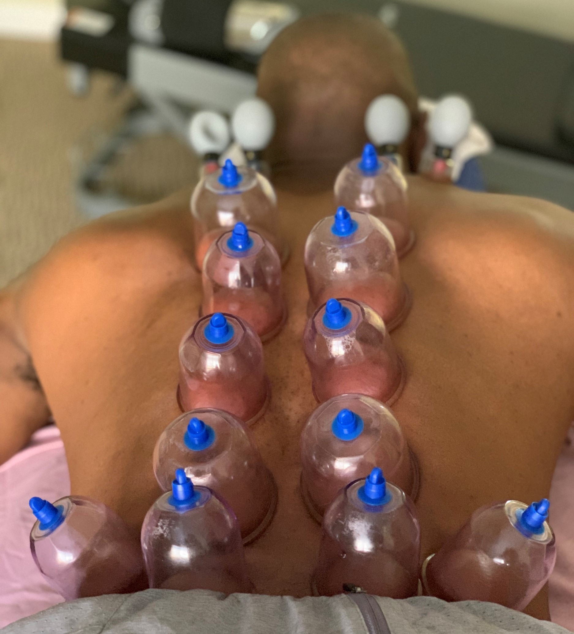 Cupping therapy treatment