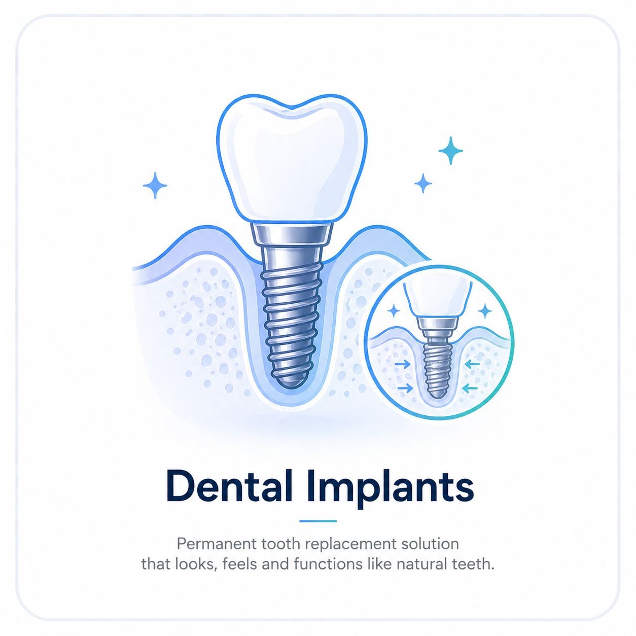 Dental Implants