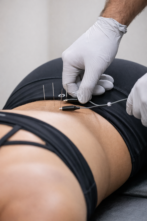 Dry needling for low back pain performed by a physical therapist in Clark, NJ