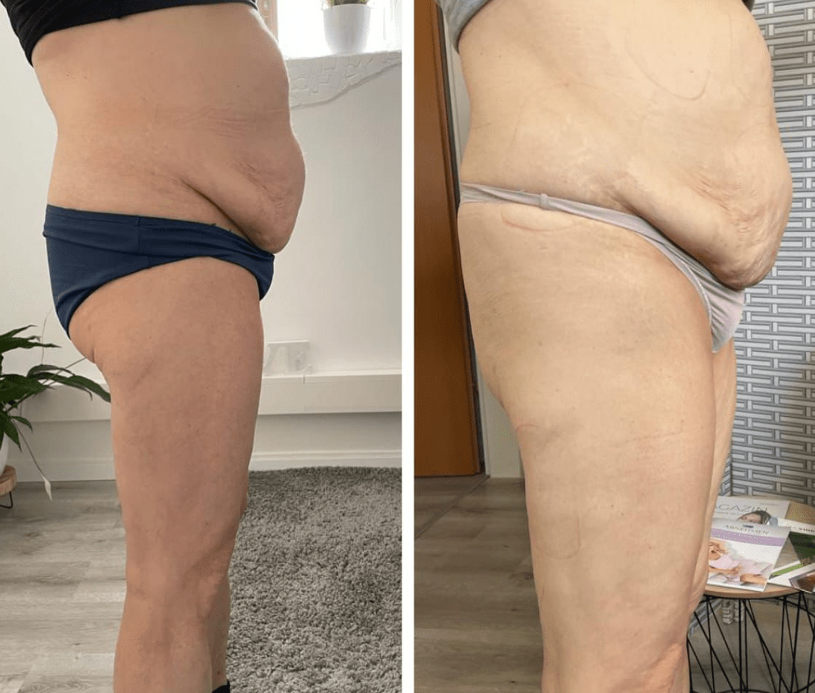 Vorher-Nachher: Beine & Cellulite