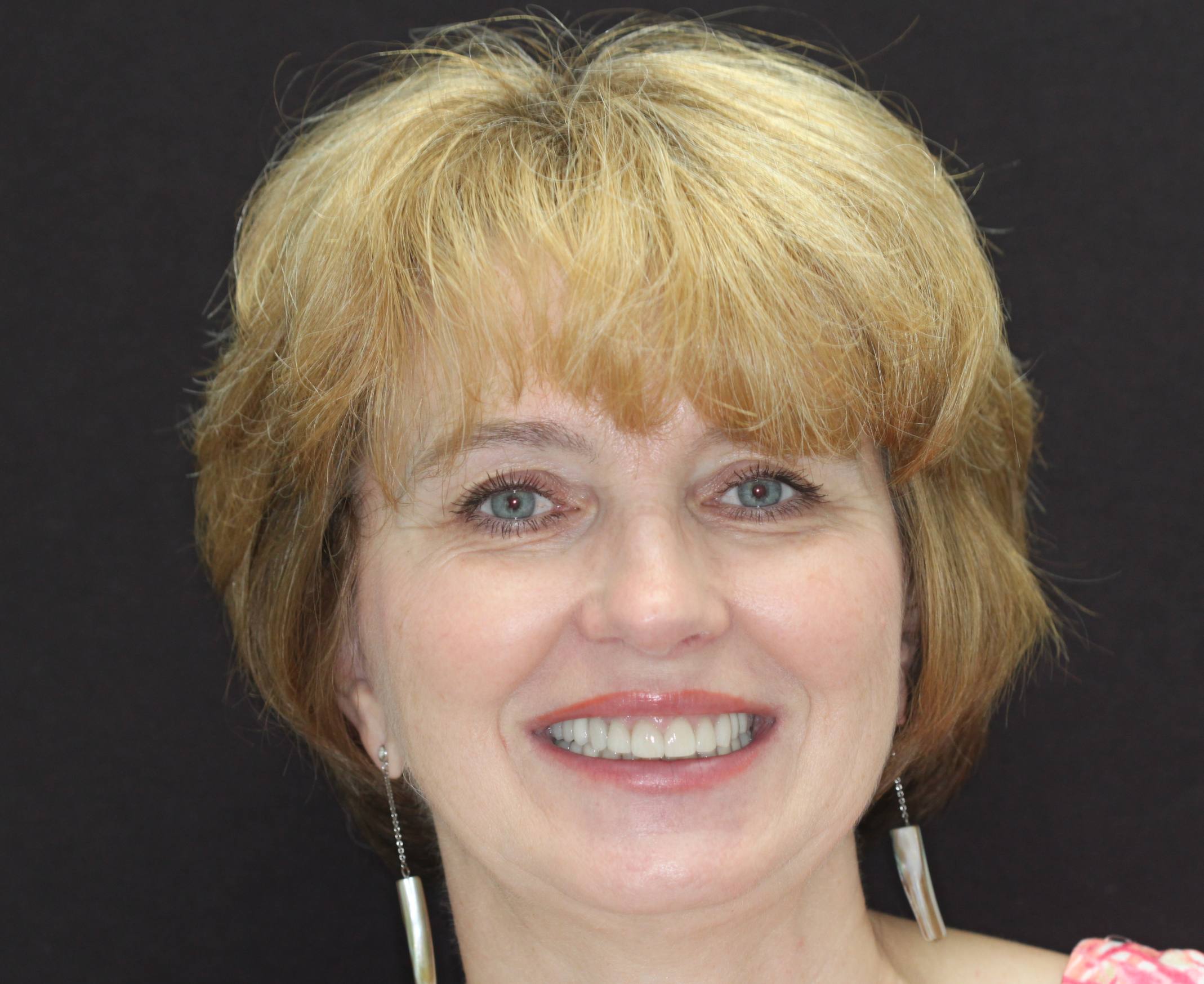 Full Mouth Rehabilitation, after treatment