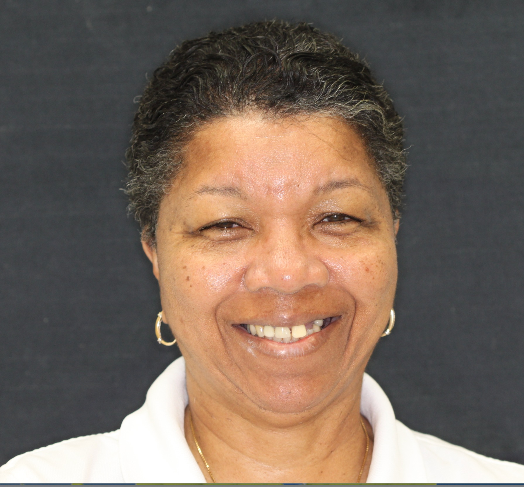 Smile Makeover, before treatment