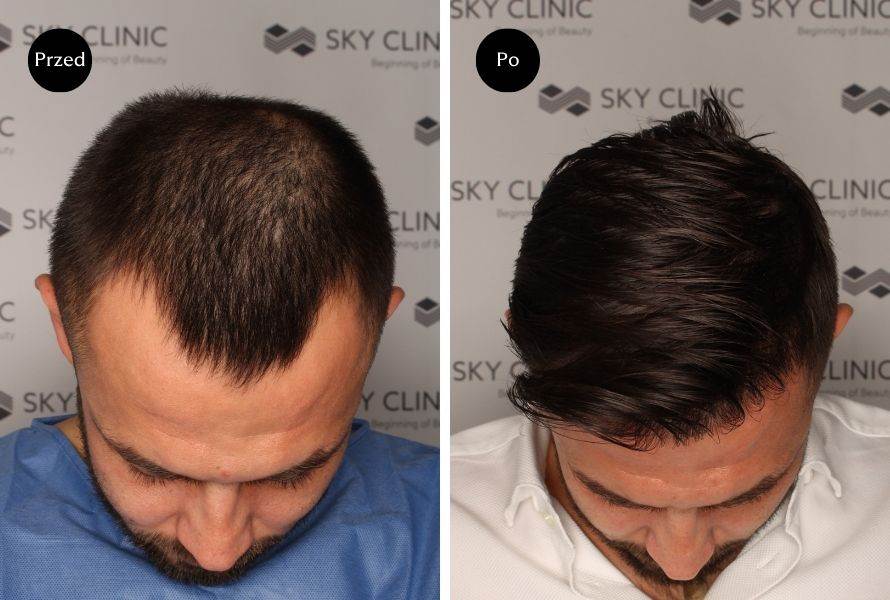 Przeszczep włosów metodą FUE